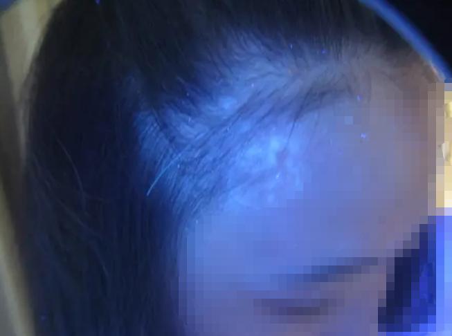 产后为什么会出现白斑？准妈妈哺乳期得了白癜风怎么办？