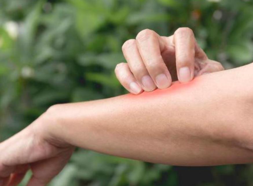 广汗法治疗银屑病效果怎么样,汗法治疗银屑病