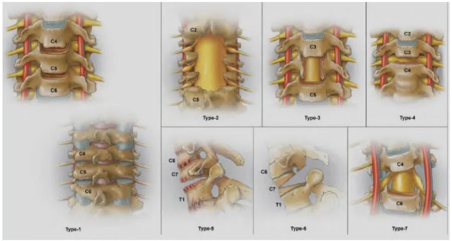 颈椎后弓畸形怎么办,颈椎后凸畸形是怎么形成的