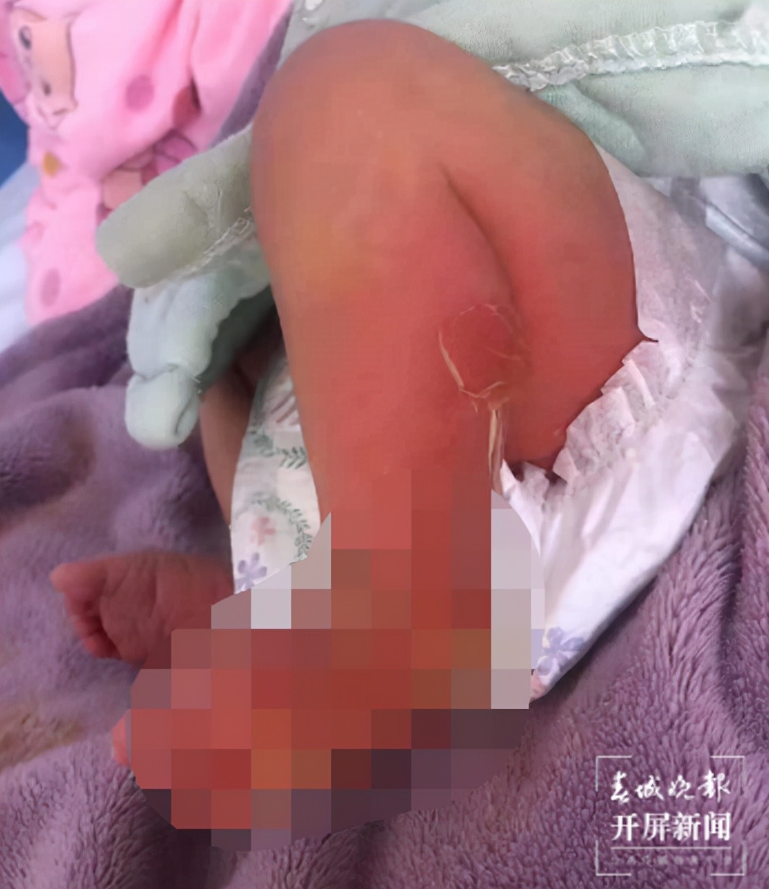 一女婴疑似在产科被烫伤,广东惠来母婴烫伤