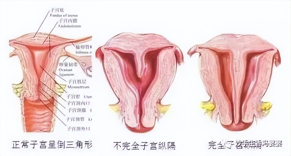 子宫畸形造成的胎停好治疗吗,子宫畸形是不是没法生孩子了