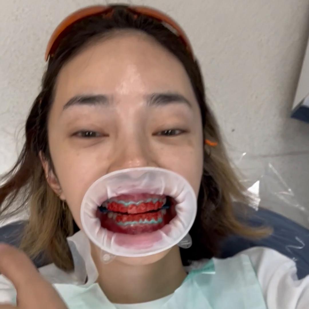 黄牙齿怎么刷才能变白,快速治疗顽固性黄牙美白牙齿神器