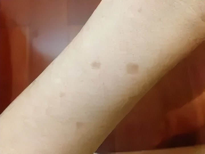 老年色素沉着斑怎么消除,色素沉着老年斑能去除吗