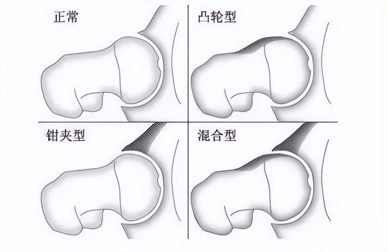 疫情期间宅家深蹲练出髋关节痛?运动不当越做越伤身