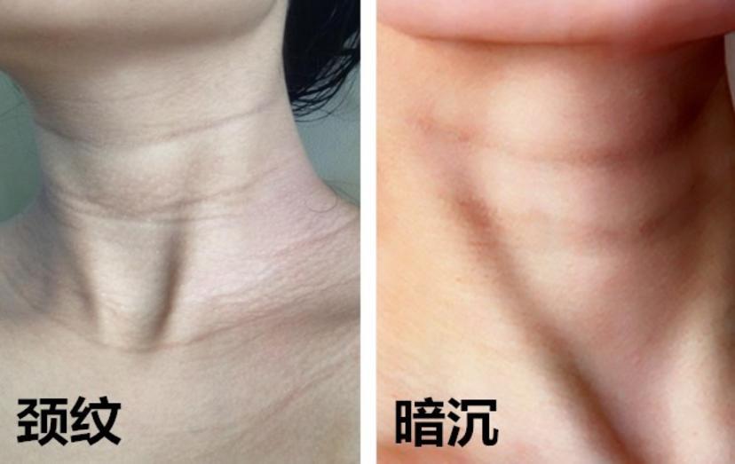 颈部保养最佳年龄,颈部保养过程中又要注意哪些问题