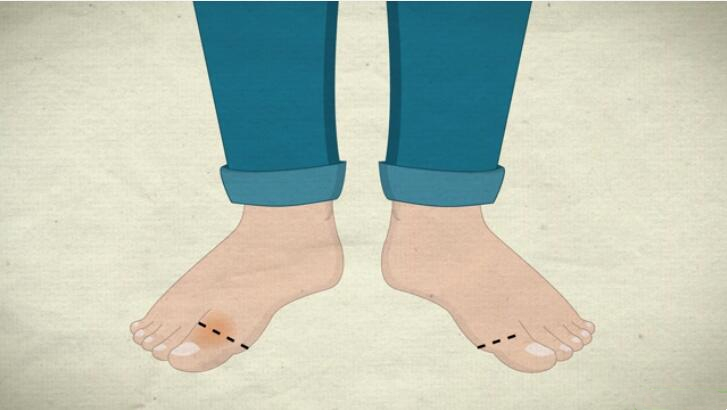 脚趾骨折断端稍分离移位,判断脚趾是骨折还是损伤的方法