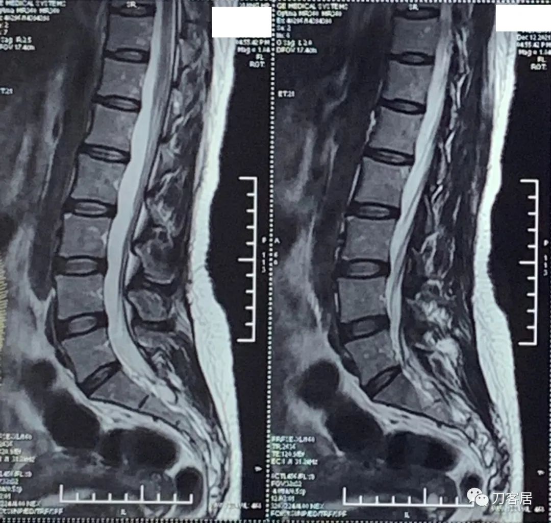 50多岁女性剧烈腰痛,40岁女人腰痛是什么原因引起的