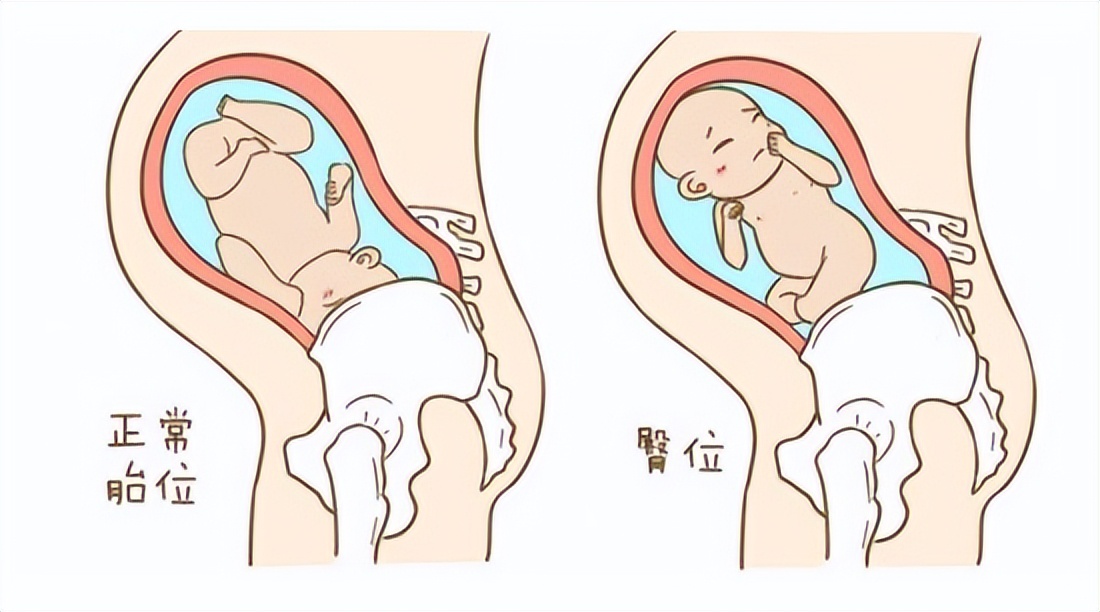 胎位不正有什么办法可以纠正,什么原因导致胎位不正