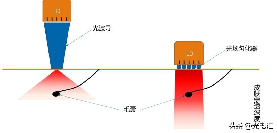 半导体激光脱毛产品技术要求,半导体激光脱毛仪能产生什么效益