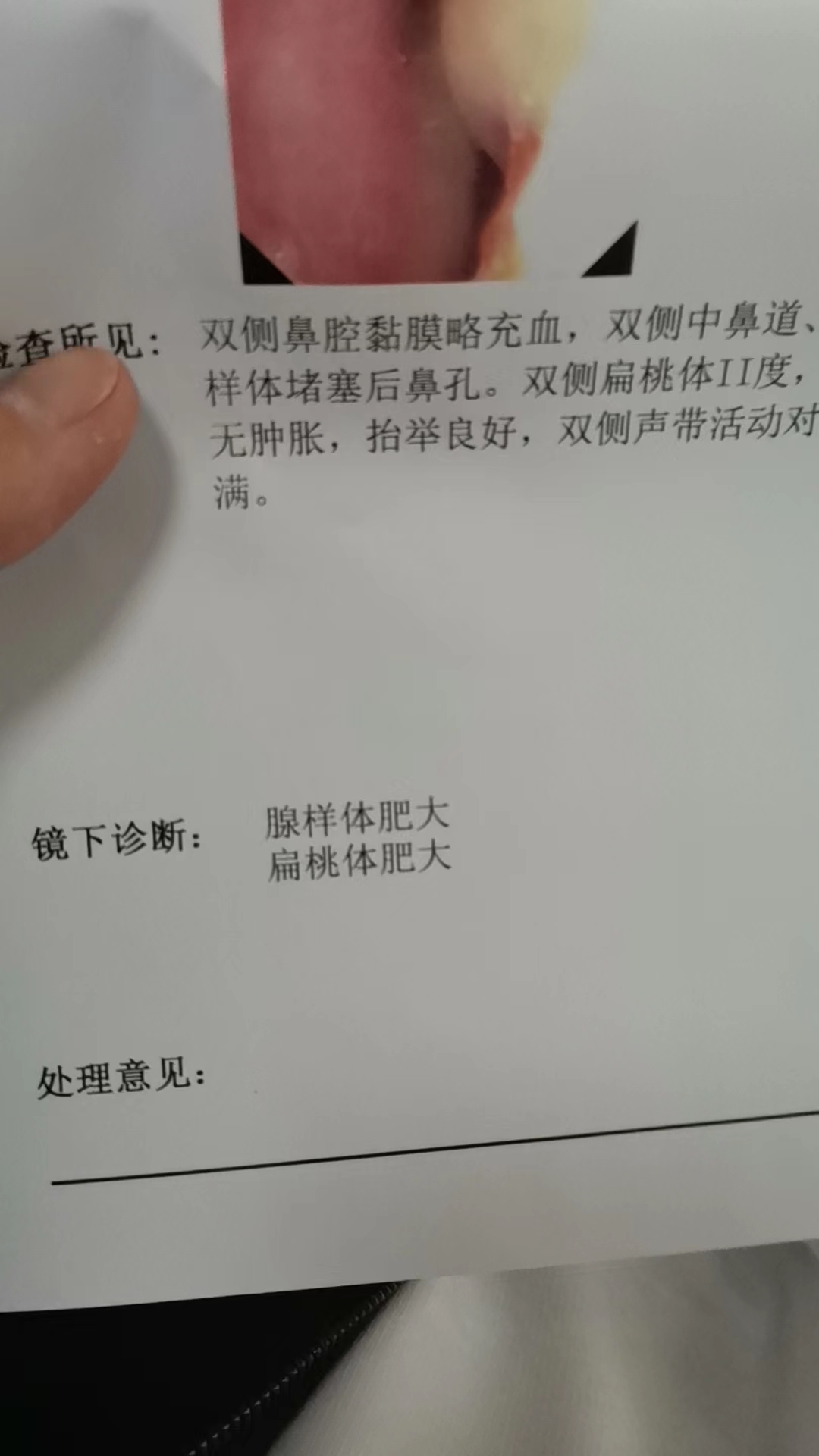 五岁孩子腺样体扁桃体大怎样调理,10岁腺样体扁桃体肥大需要手术吗