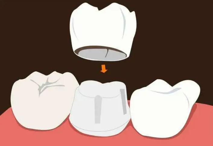 做了根管治疗的牙劈了怎么办,根管治疗以后牙劈了还能再补吗