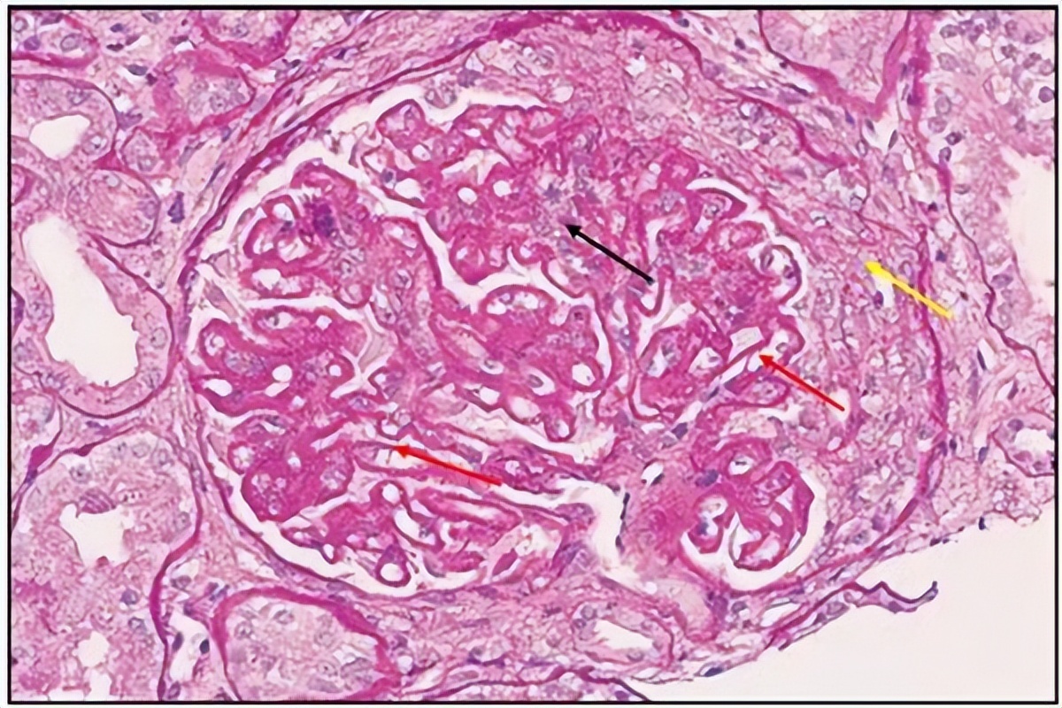 狼疮性肾炎吃药多久尿蛋白转阴,女性狼疮