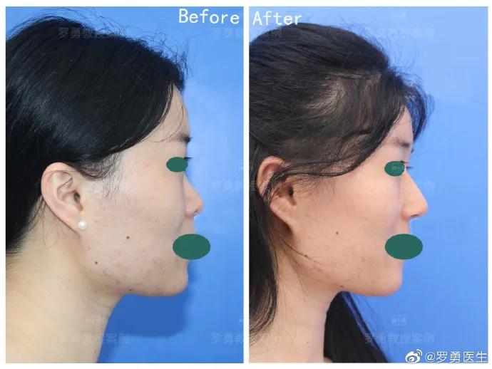 鼻综合鼻头挛缩山根太高怎么修复,鼻综合后山根太低