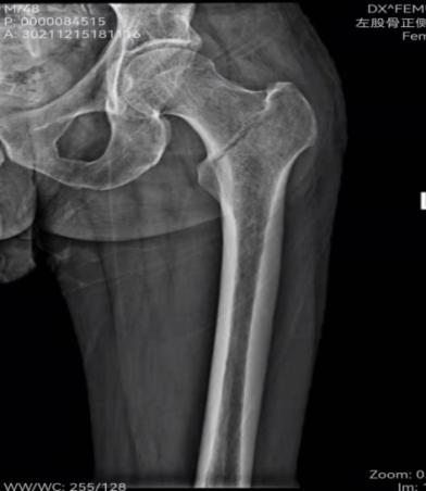 烟台海港医院用新技术PFBN助力，治疗股骨粗隆间骨折