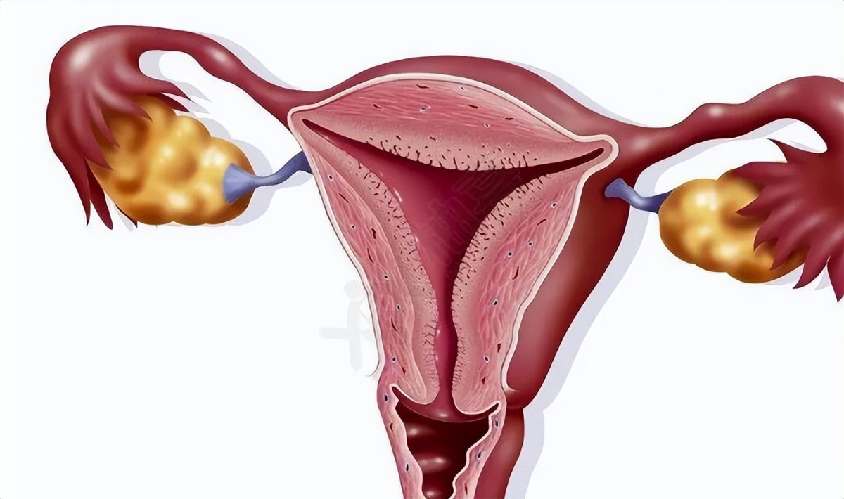 子宫有息肉,子宫里有息肉正常吗