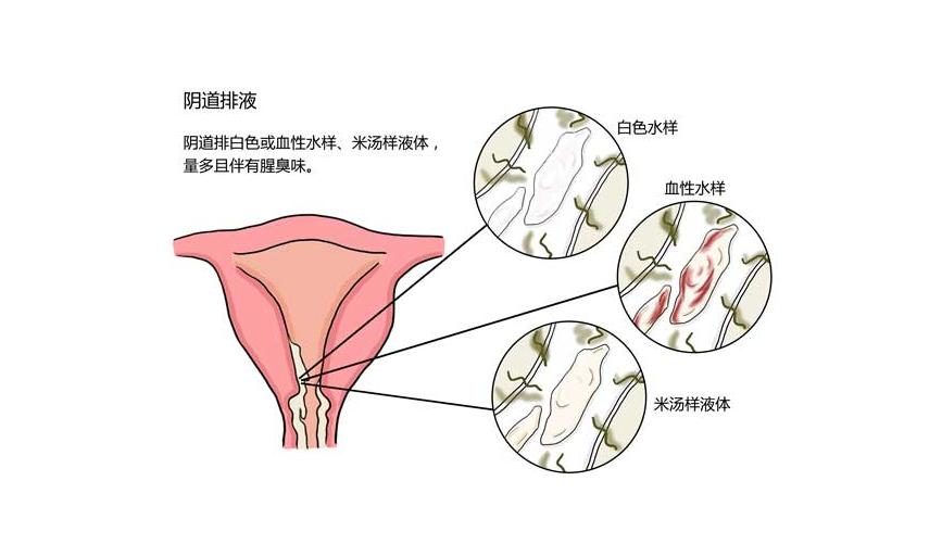子宫癌早期的三种症状,子宫癌早期10种症状