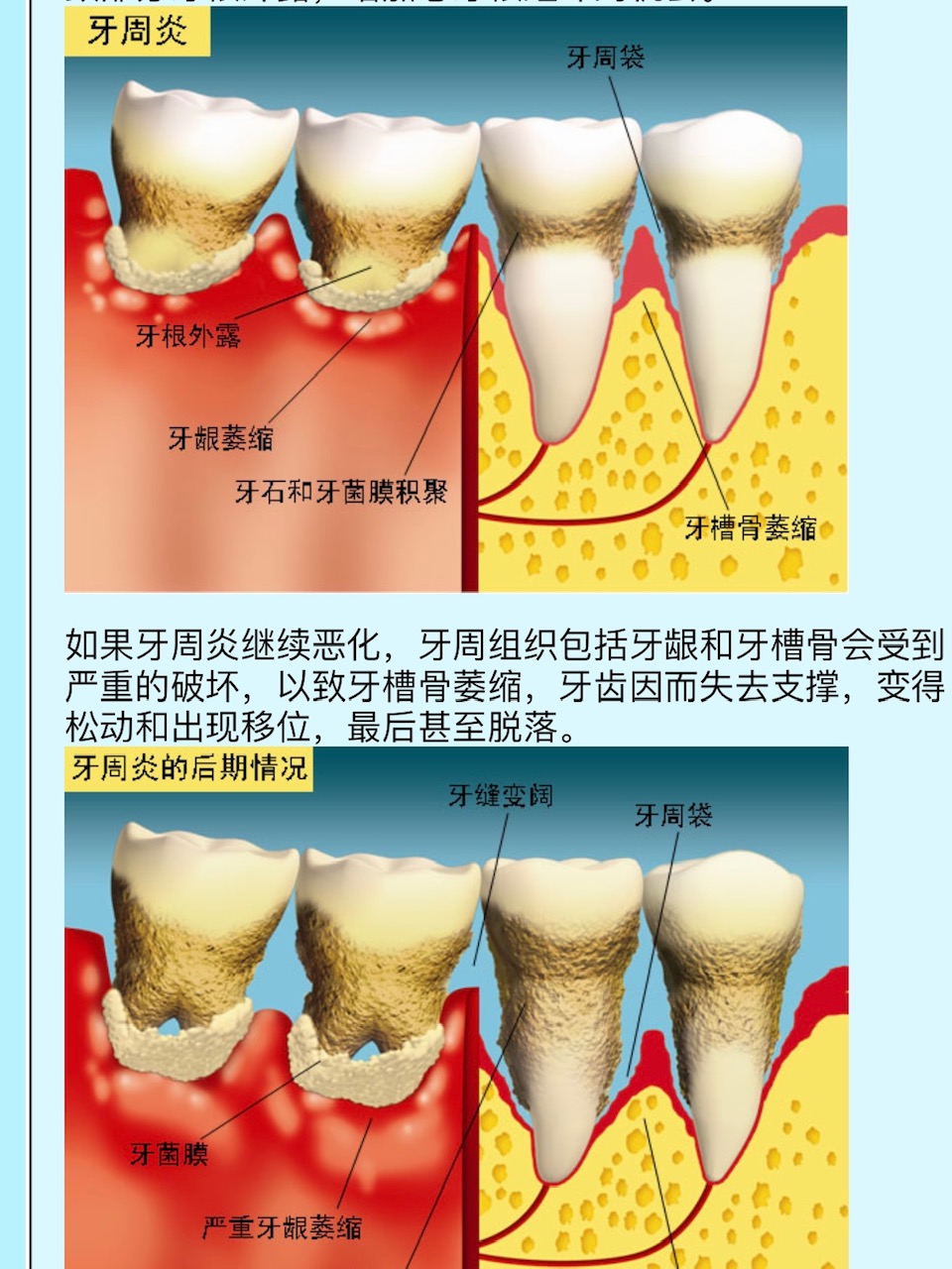 修复牙龈能治疗牙龈萎缩的牙膏,修复牙龈萎缩最好牙膏进口