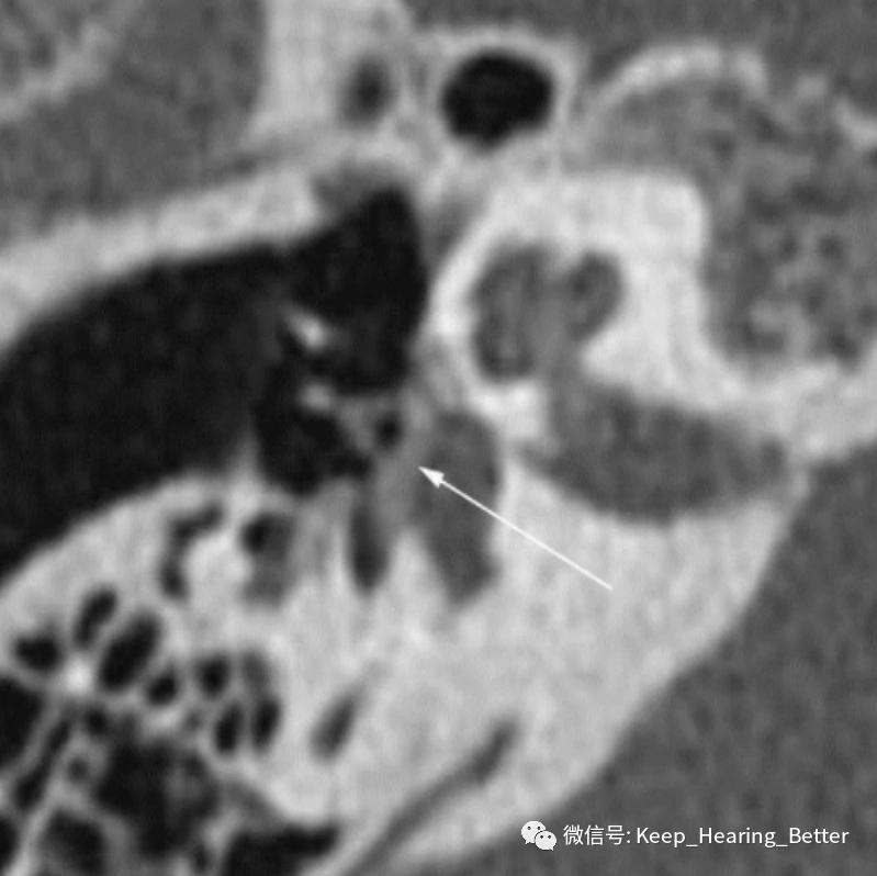 南昌大学二附院耳喉科,耳膜硬化症是什么样子