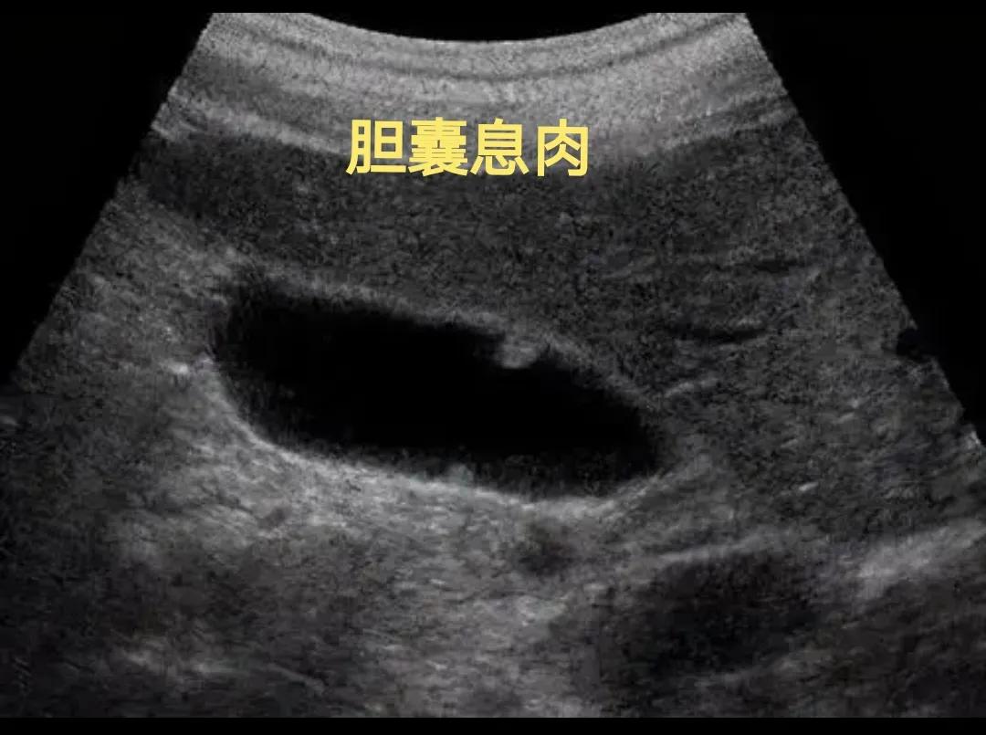 体检报告出现“息肉”，5种常见息肉哪些是良性，哪些会癌变？