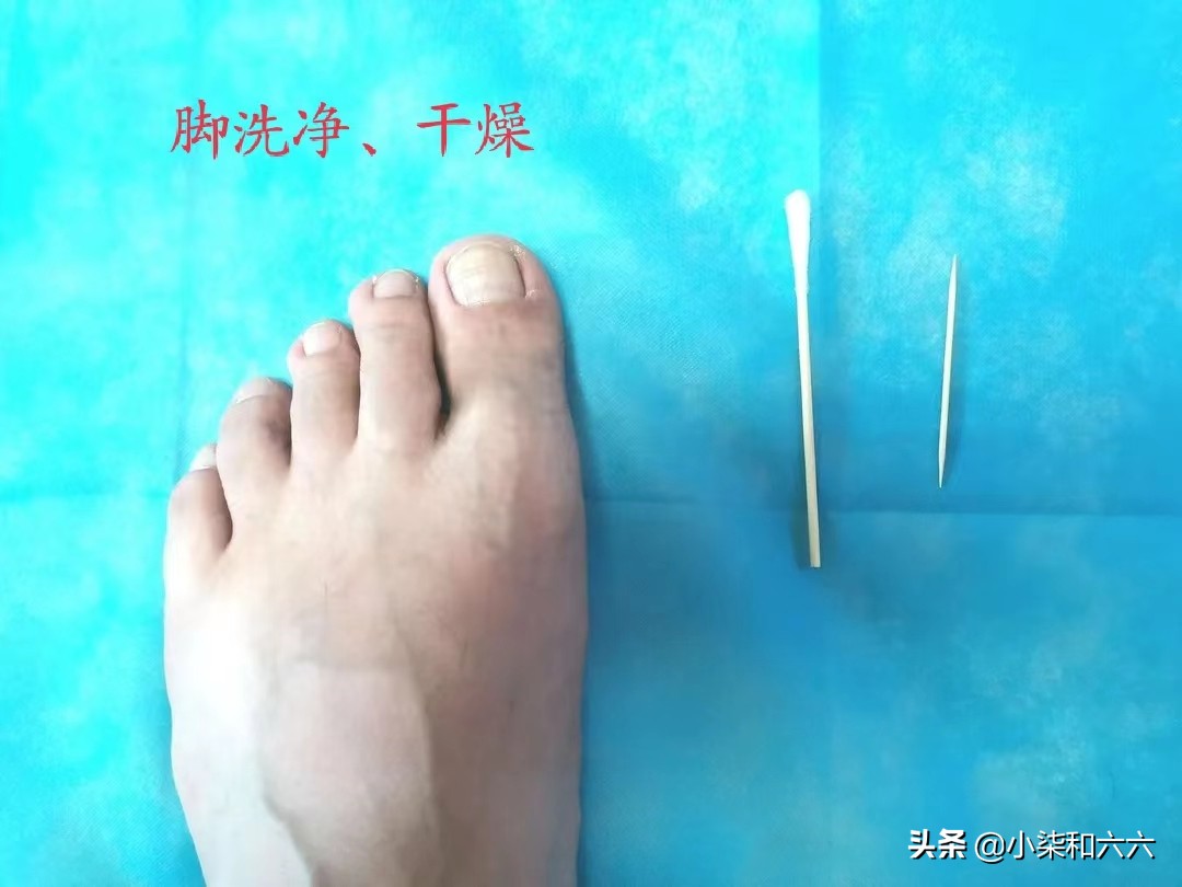 得了甲沟炎该怎么办？千万别急着拔甲