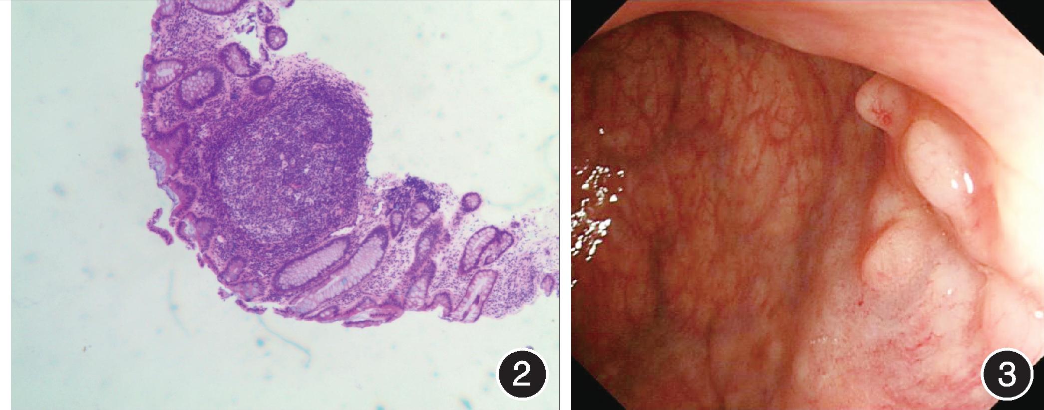 沙眼衣原体感染直肠炎,衣原体感染会引起直肠炎吗