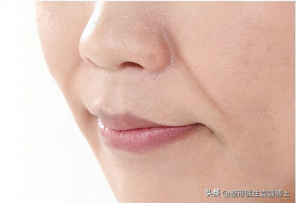 不做拉皮如何改善法令纹,法令纹严重拉皮可以改善吗