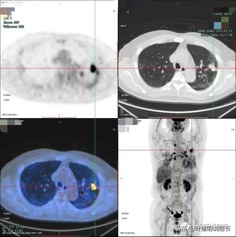 pet判断淋巴结转移,petct判断癌有没有转移准确吗