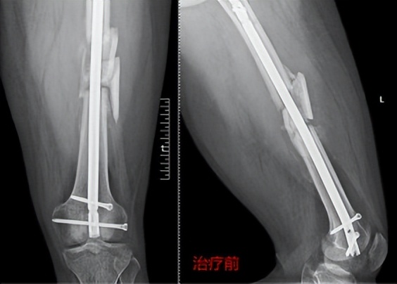 骨冲击波治疗仪,治骨疼痛最特效药方