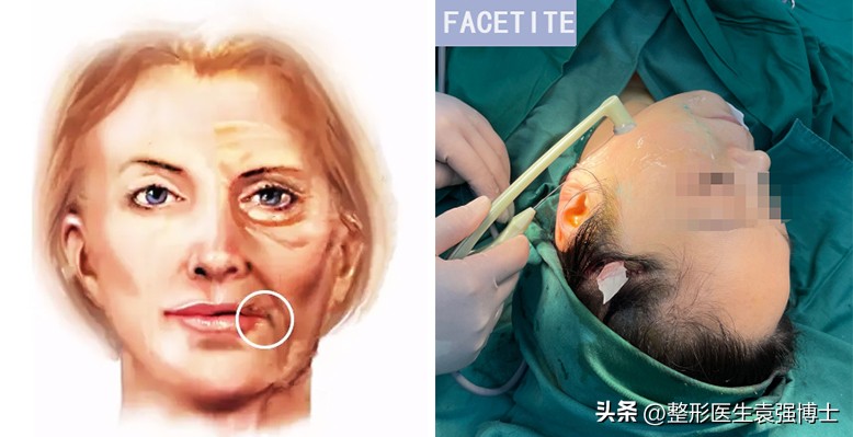 面部皮肤松弛形成口角囊袋,口角囊袋是皮肤松弛的结果吗