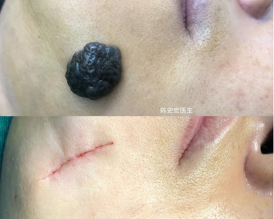 什么药水点痣不留疤痕,网上那些点痣药水真的假的