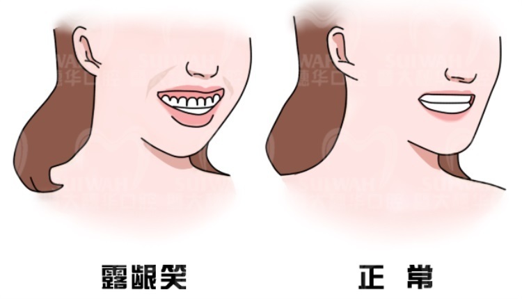 有一种“颜值杀手”叫露龈笑，这种情况该如何应对？