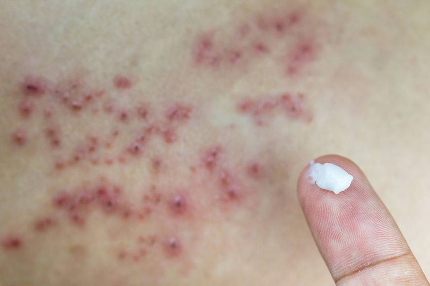 皮炎湿疹用药,外阴皮炎湿疹用药