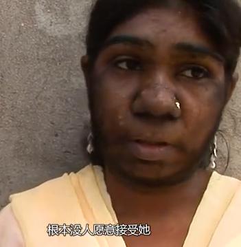 故事:非洲17岁女孩长满络腮胡,毛发从鼻孔长到脖子,身体有何异常