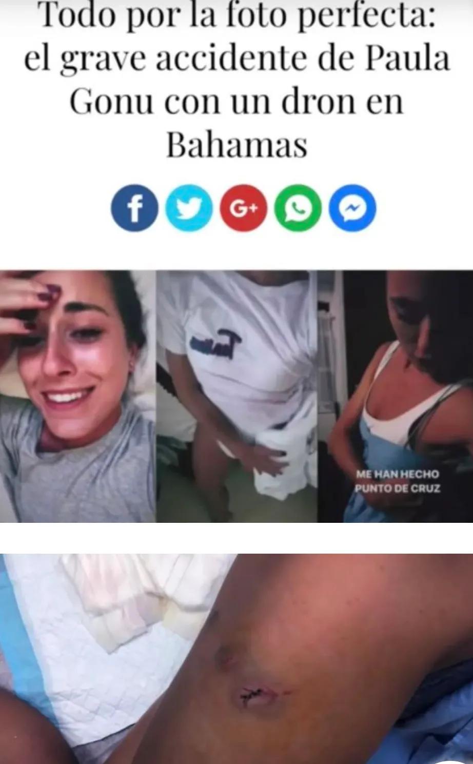 震惊！外国网红做手术切除膝盖软骨后，竟煮熟与男友一同食用