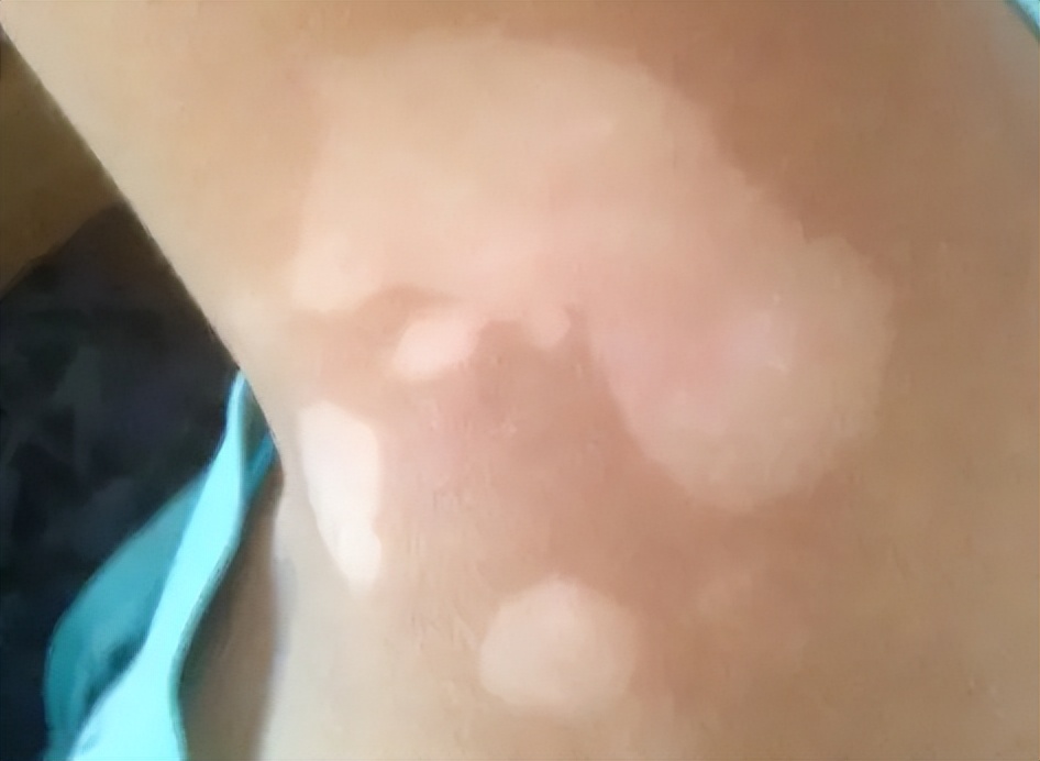 怎么知道白癜风治疗有效果,引起白癜风的主要因素有哪些呢