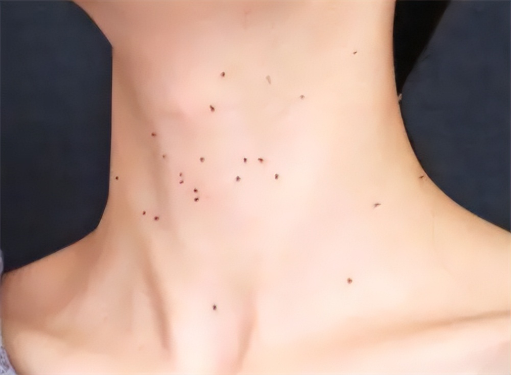 ​女性3个地方痒，或不是过敏，可能是HPV来“敲门”，别不当回事