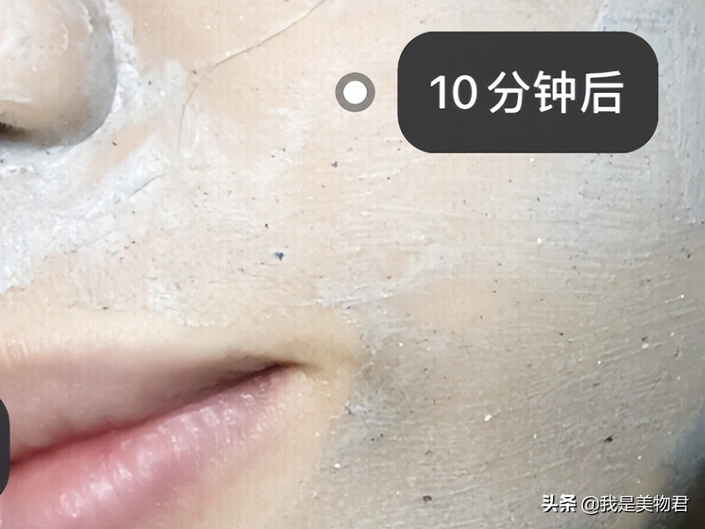 改善毛孔堵塞闭口粉刺,毛孔清道夫去闭口粉刺