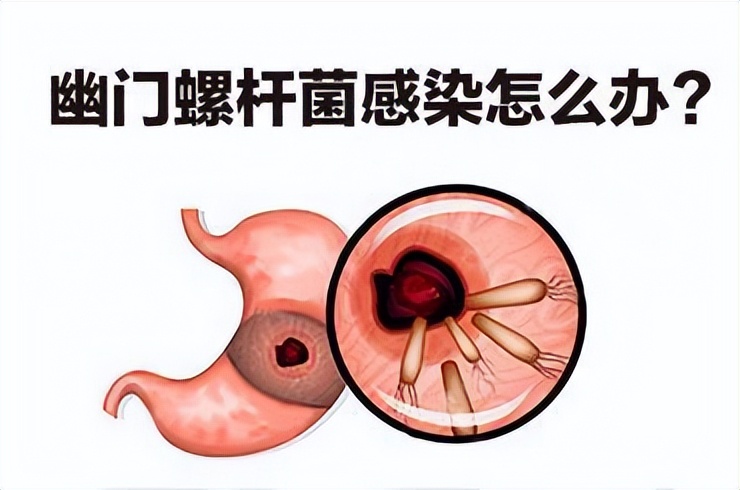 阿莫西林是好药只对5种病有效,阿莫西林禁忌症有哪些