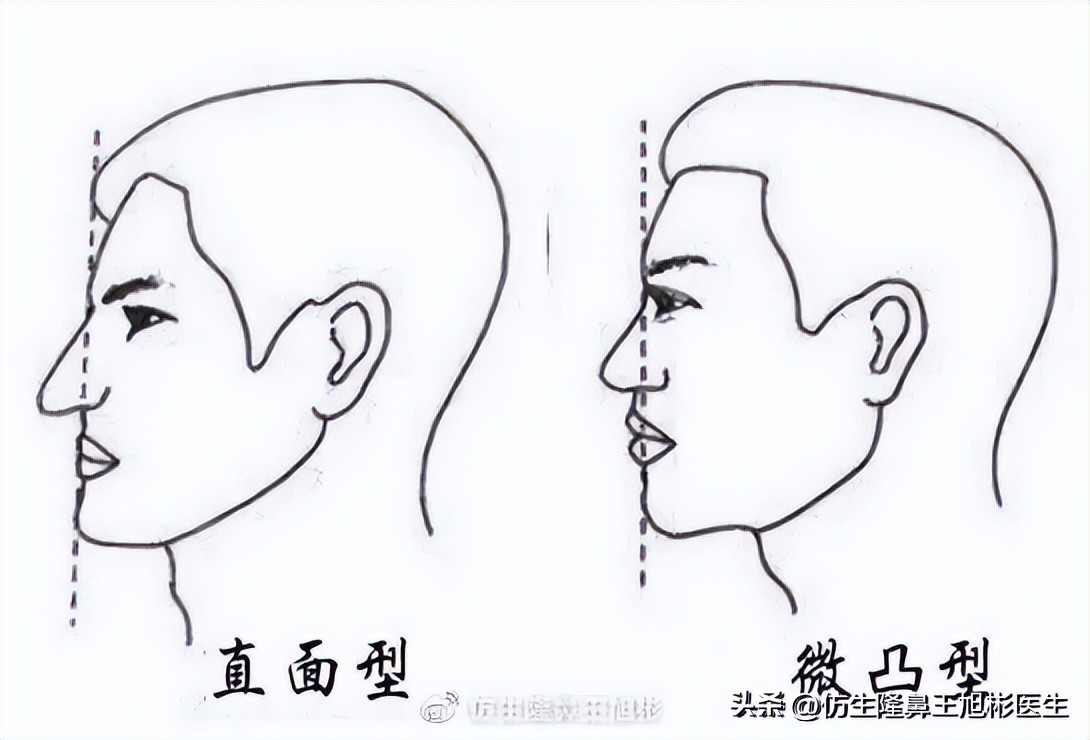 隆鼻鼻型科普,鼻基底凹陷隆鼻可以改善吗