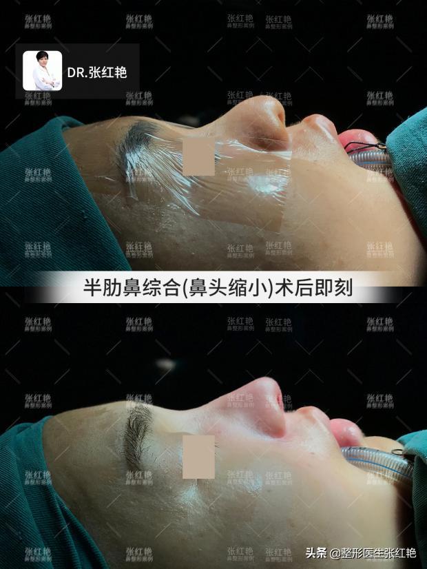 驼峰鼻的矫正八大处,河南驼峰鼻矫正大约费用是多少