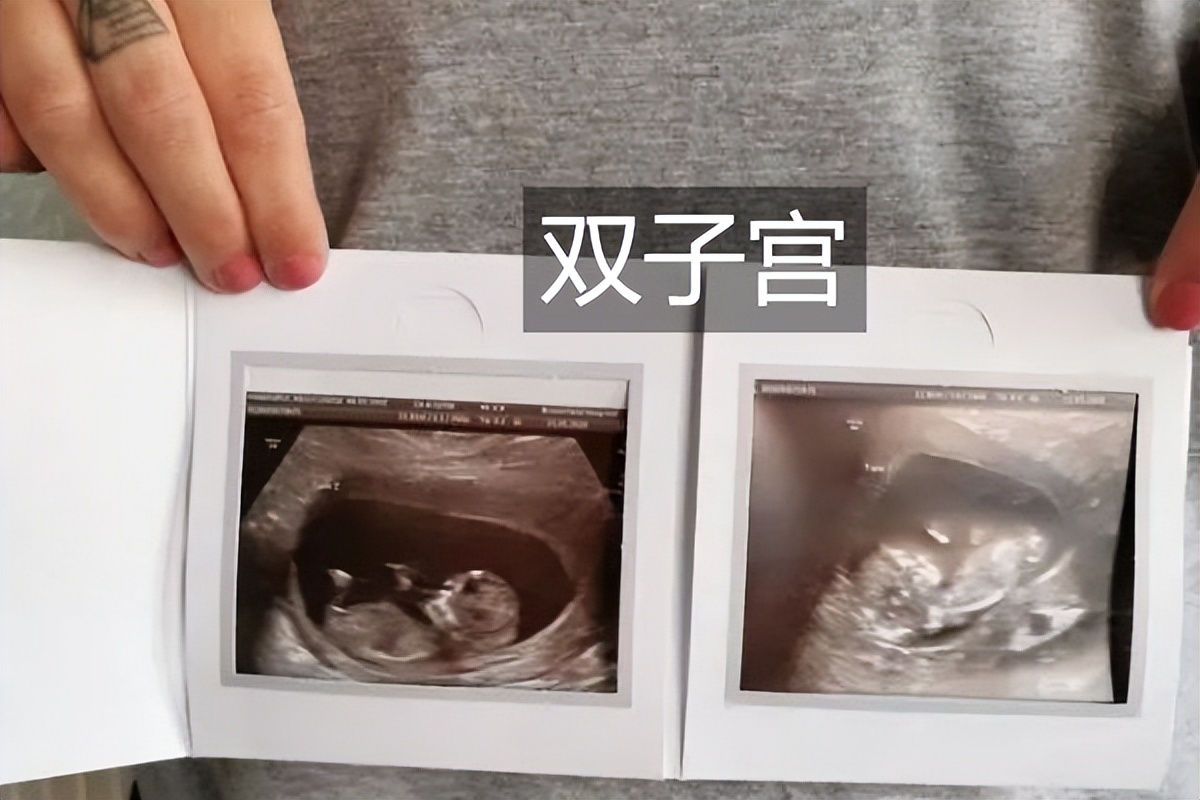 女子检查身体发现自己有两个子宫,女子查出有两个子宫