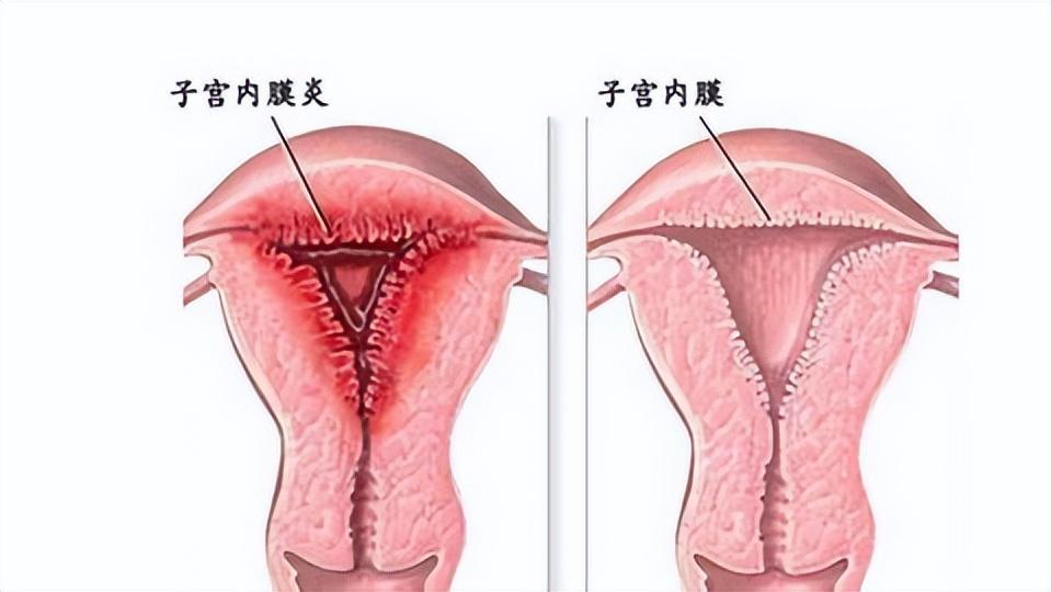 健康女性摘除子宫有影响吗,关爱女性健康不要堕胎
