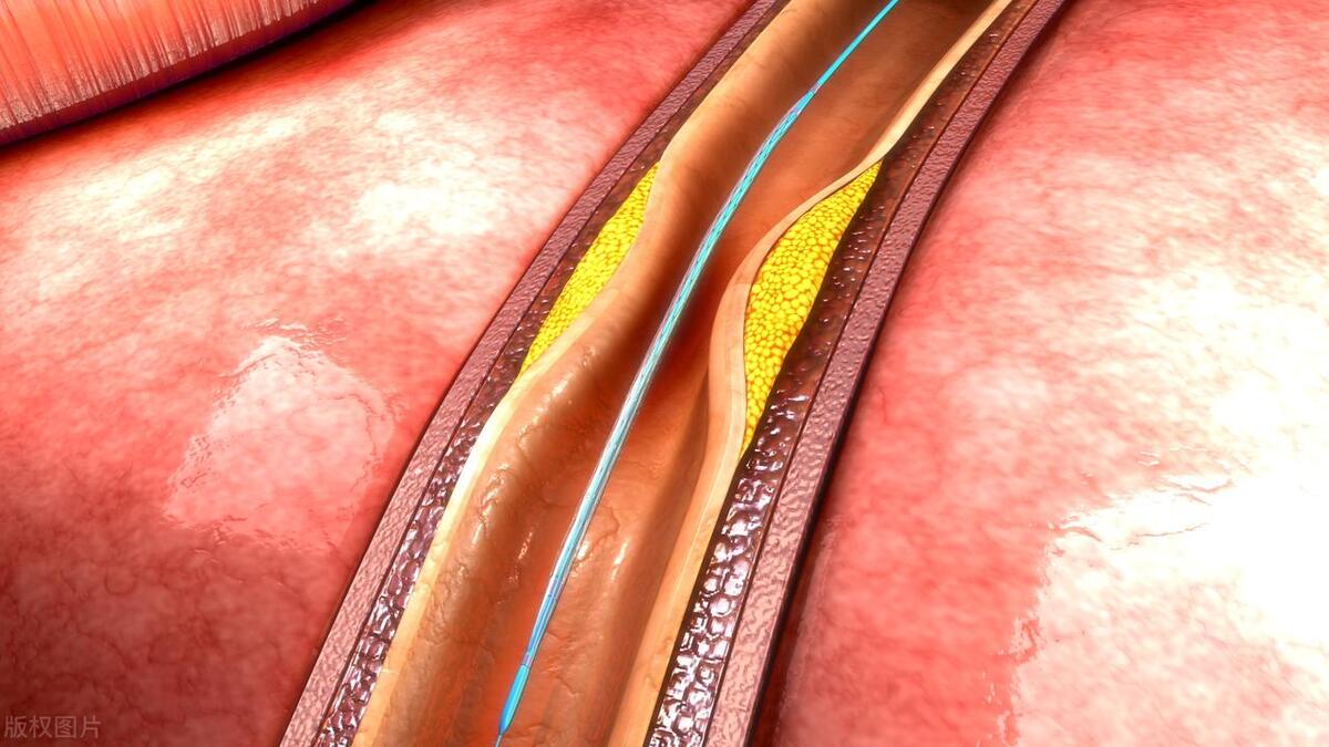 支架术后两年替格瑞洛能停不,安支架一年后是否停替格瑞洛