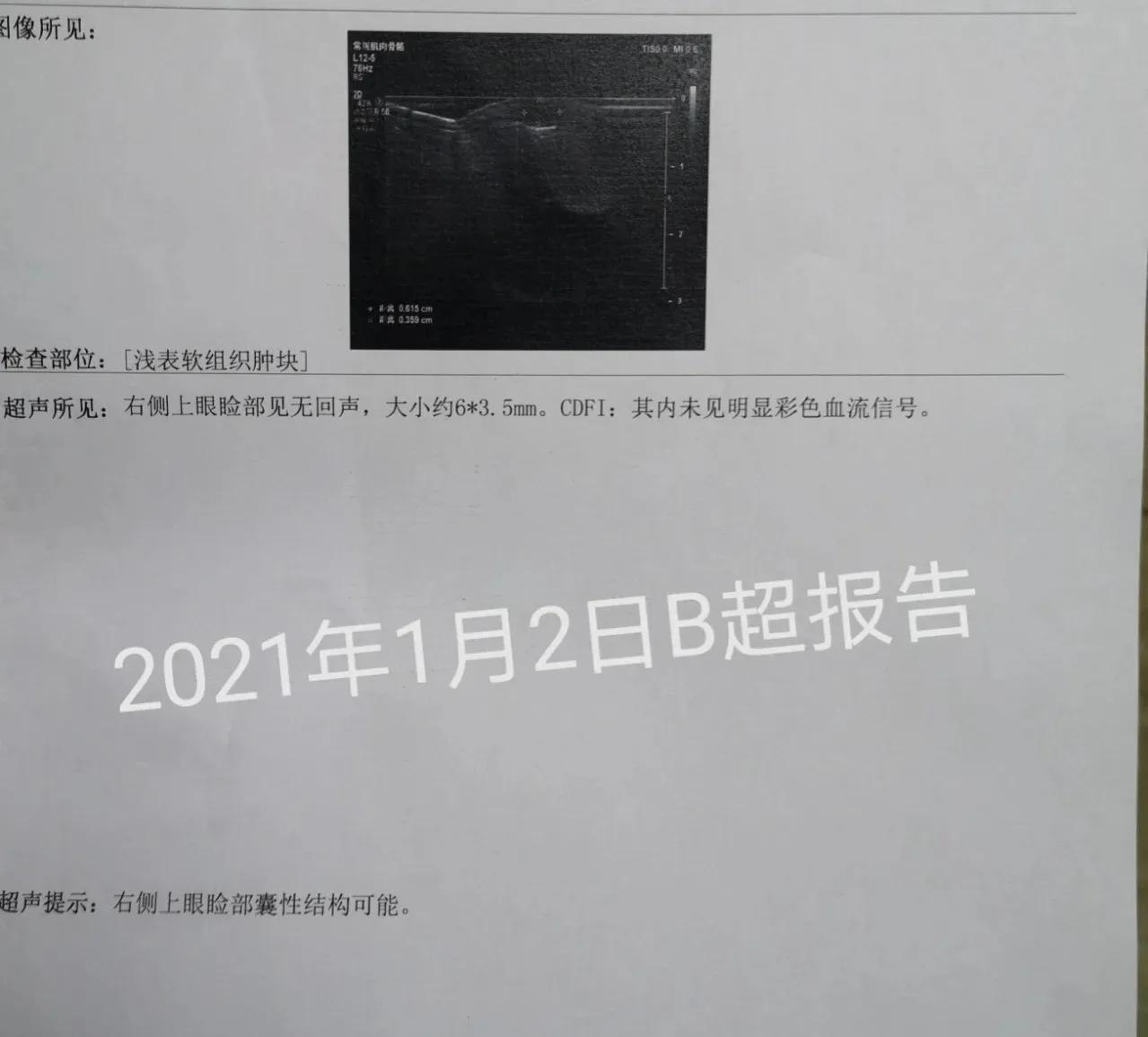 皮脂腺囊肿和粉刺瘤,火针治疗皮脂腺囊肿