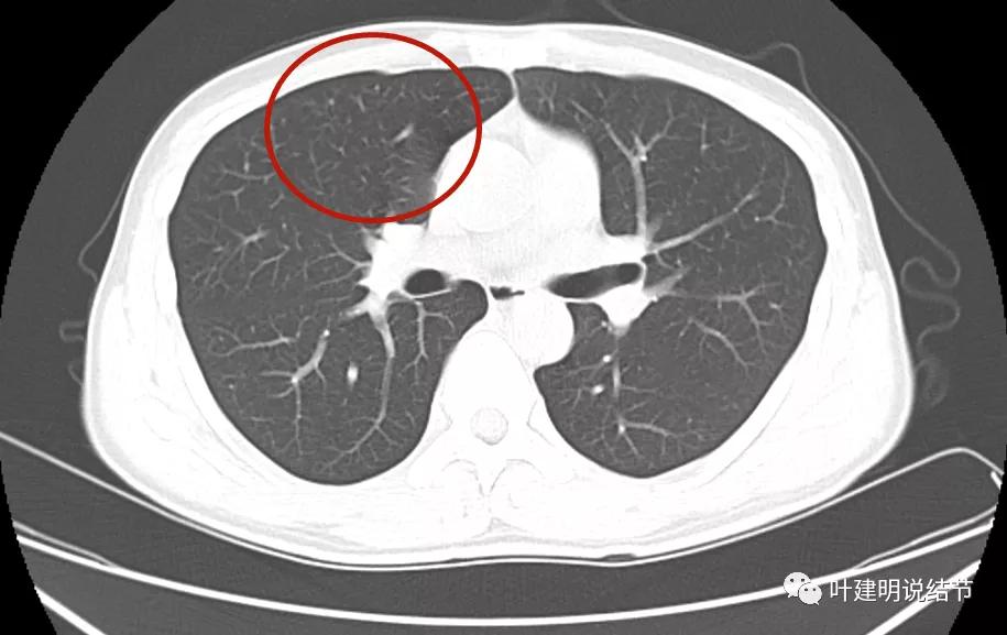 这样的多发病灶给试验性抗结核治疗?消失的结节是药的功劳吗?