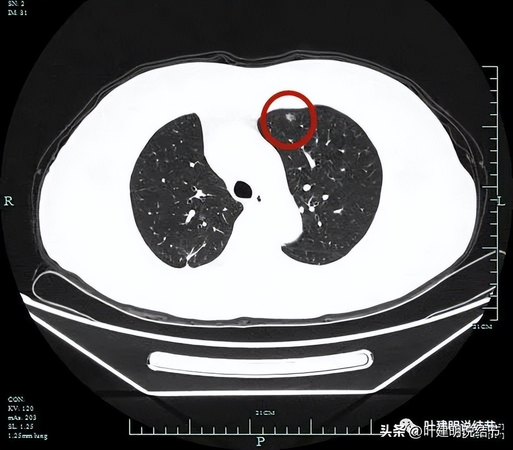 右下叶磨玻璃6mm结节基本上是癌,右下叶少许炎症上叶磨玻璃结节