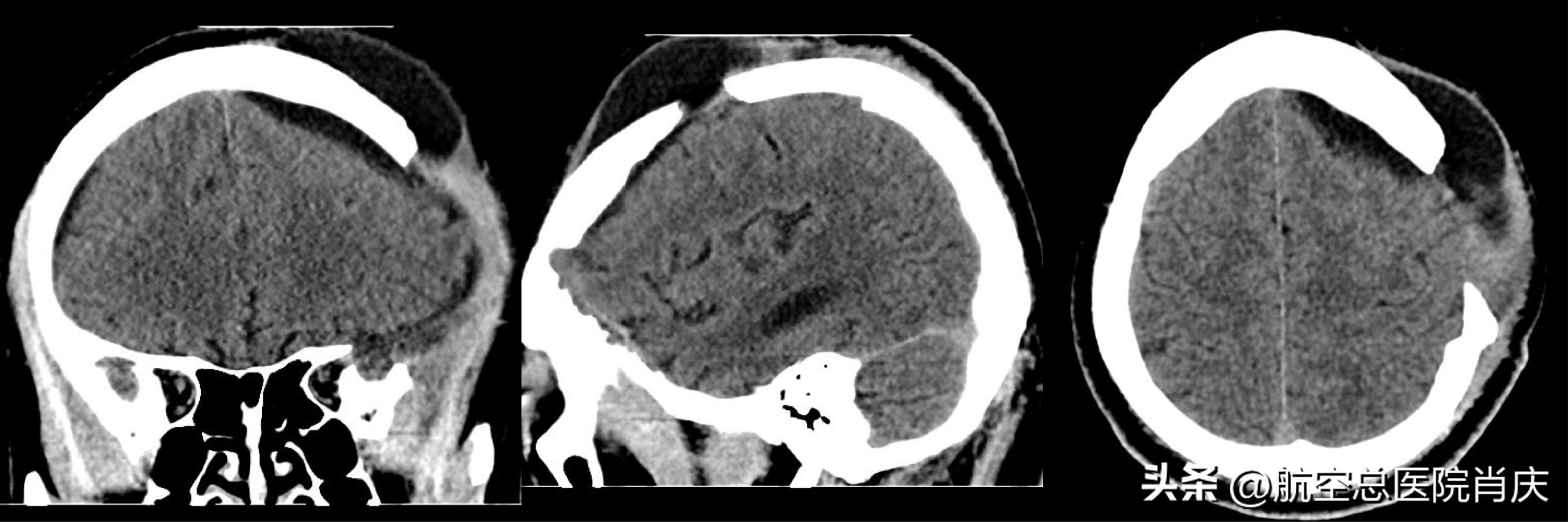 脑外伤开颅手术高烧是怎么回事,脑外伤昏迷病人苏醒恢复意识
