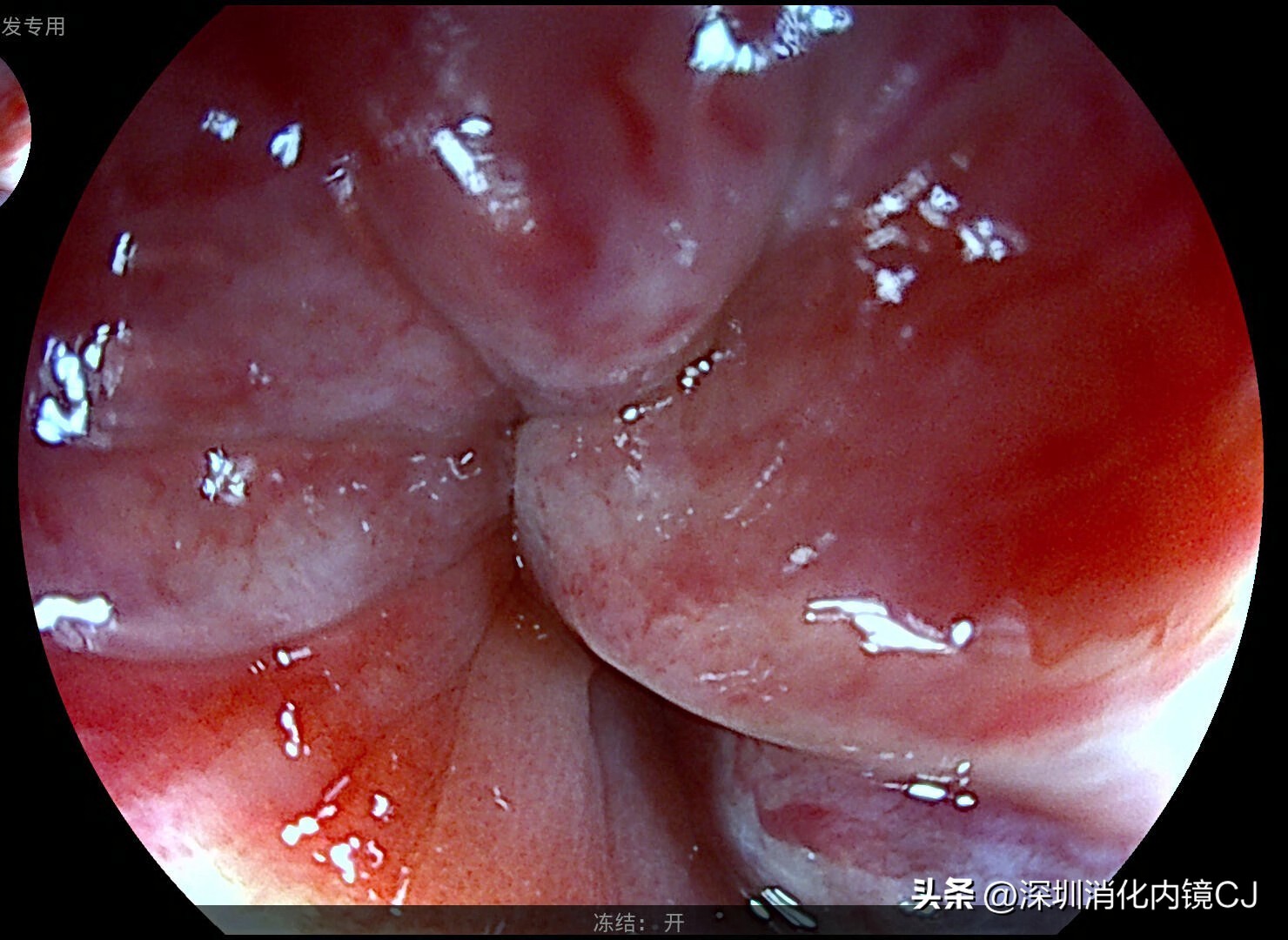 iii型痔疮,哪些痔疮患者适合内镜下套扎治疗