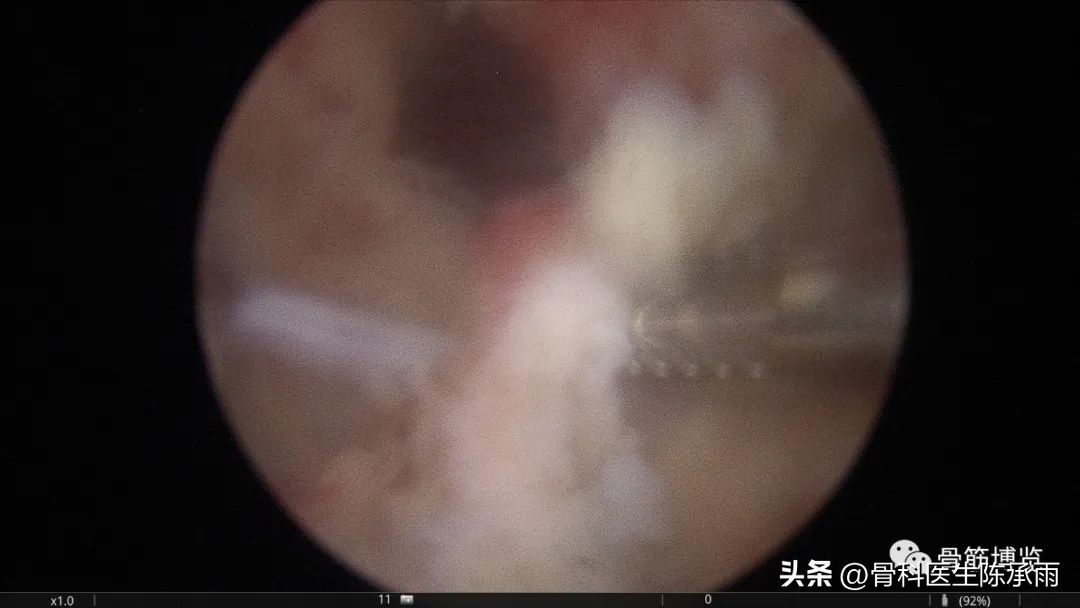 化脓性关节炎的穿刺引流治疗,关节炎镜下治疗