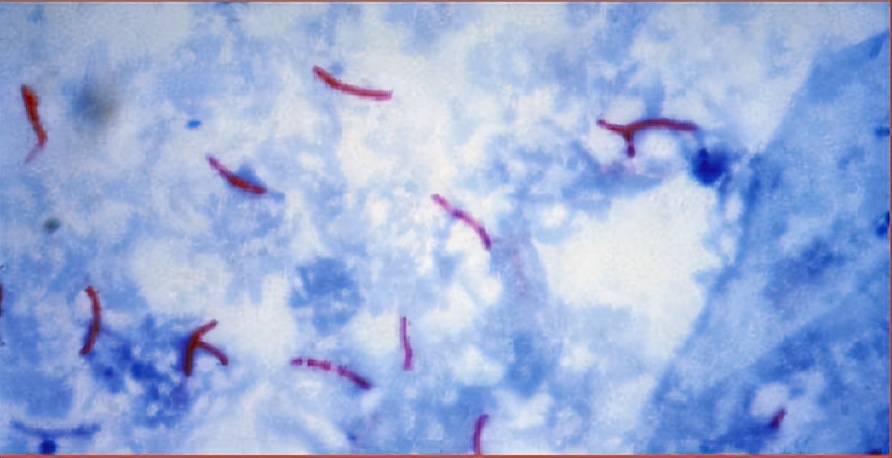 新冠疫情下，我们抗击耐药结核病变得更加艰难